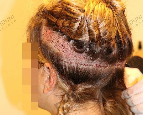 Partial shaving for women: In this case, a scar correction of an unsuccessful FUT hair transplant was carried out at the same time 