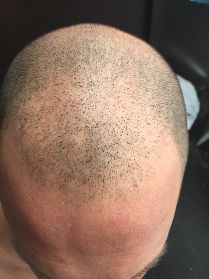 Hair transplant Istanbul with negative experiences: Recipient area after failed surgery
