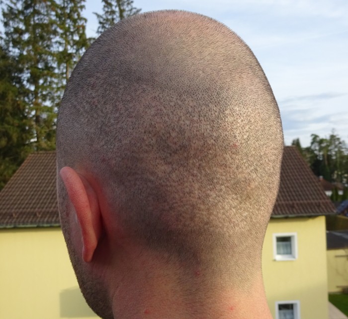 Hair transplant Istanbul and football field/window optic after FUE - left back