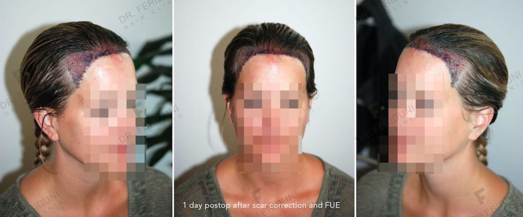 Example of a women's hair restoration of the receding hairline and high forehead without shaving the recipient area 