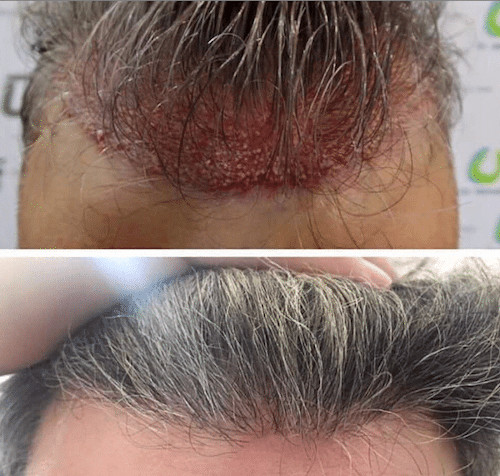 Hair transplant without shaving head 