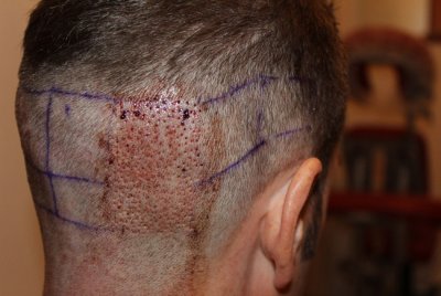 FUE Hair transplant with the shaving of the complete donor area
