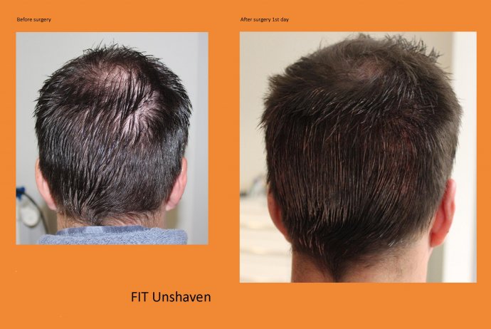 In the picture above directly after an Unshaven hair transplantation with abandonment of any shaving, completely unshaven band of hair /donor