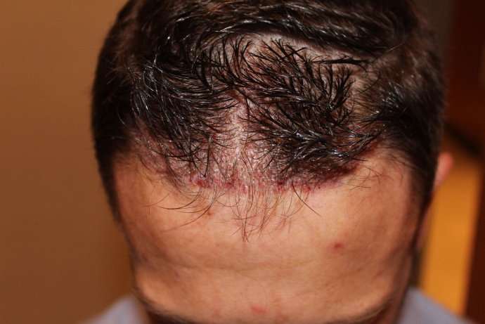 Picture directly after transplanting the grafts with the Unshaven method into the existing hair in the hairline and in the receding hairline. The longer-existing hair remains uncut!