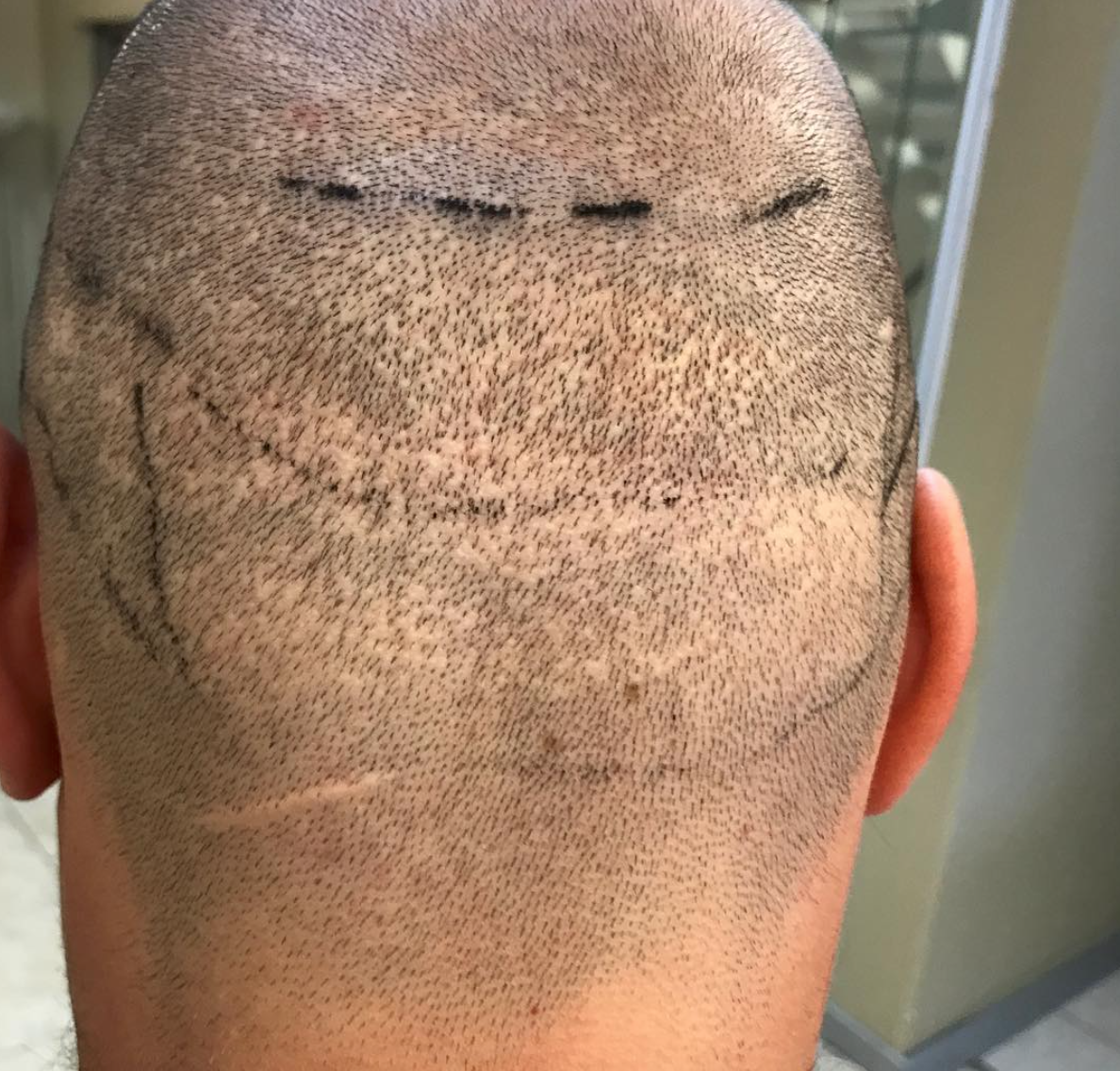 Hair transplantation Turkey Istanbul: Botched donor with moth-eaten appearance after an FUE with micromotor