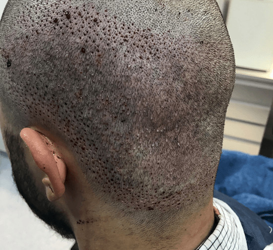 Destroyed donor area after FUE: Repair - Immediately after donor restoration