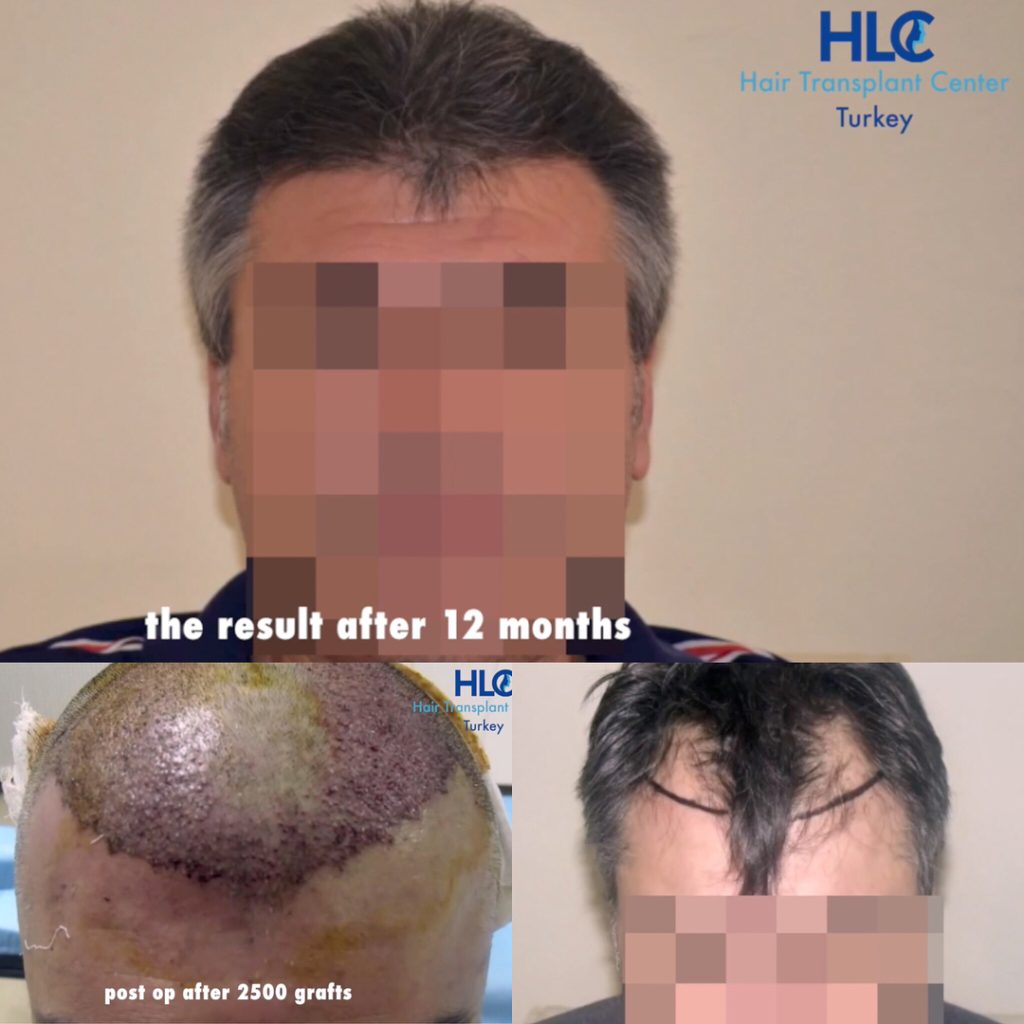 Hair transplantation résult turkey 2500 Grafts by the hairline clinic