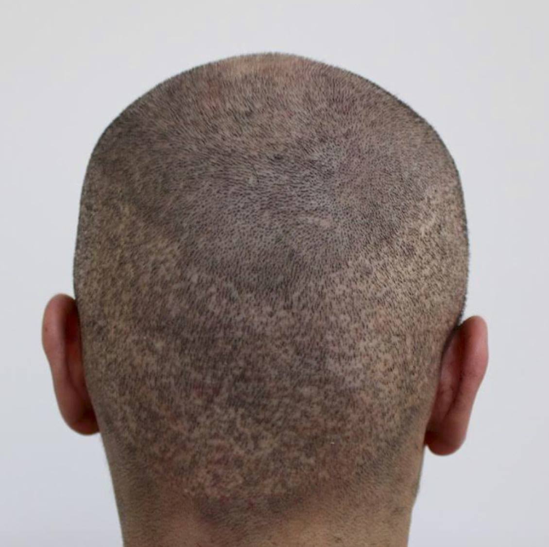 Thinned out donor area after botched Turkey hair transplant: Before with shaving - 2