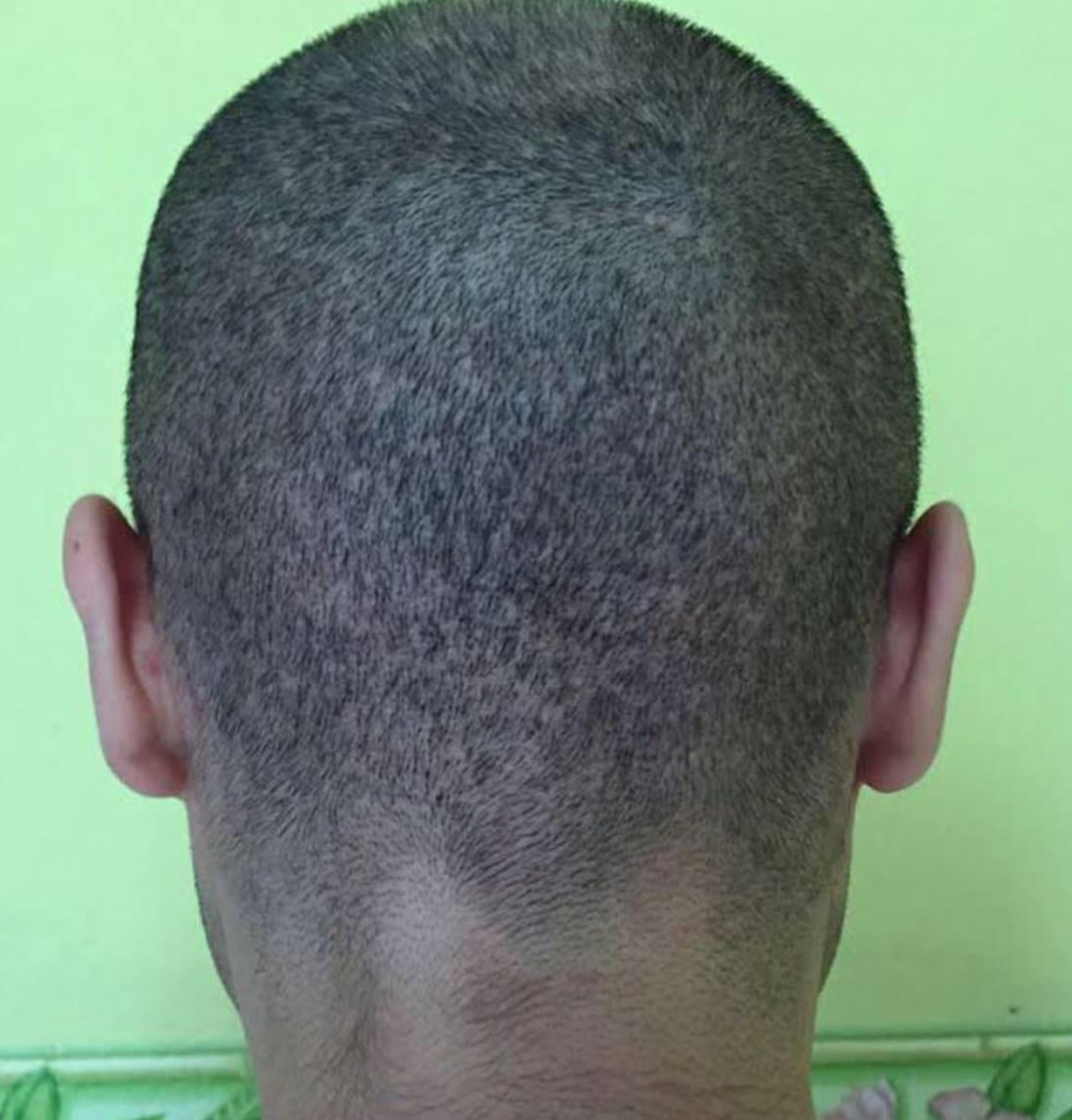 Result of scalp pigmentation after botched FUE hair transplant in Turkey