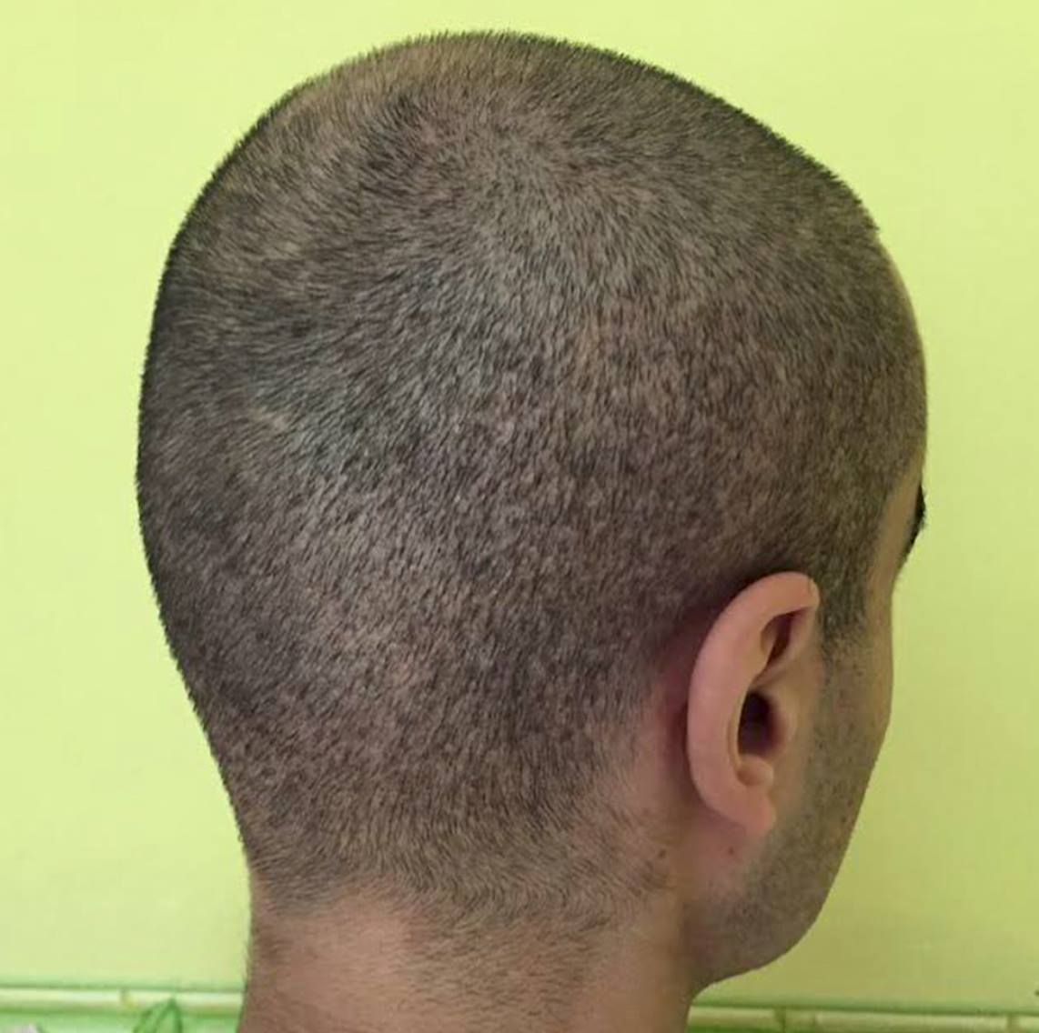 Result of scalp pigmentation after botched FUE