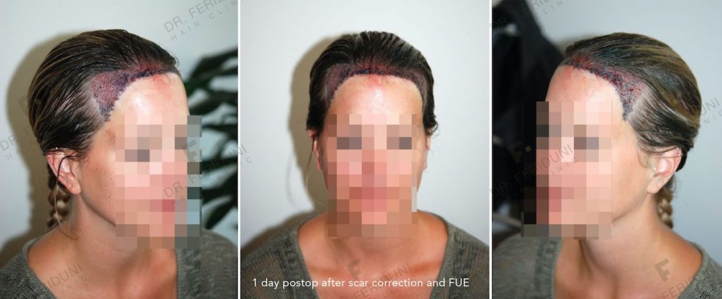 The Women Hair Transplant and 1 day after scar correction and FUE of the hairline and receding hairline corners without shaving the recipient area