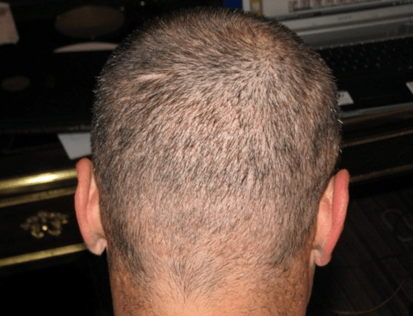 10 days after the follicular unit extraction