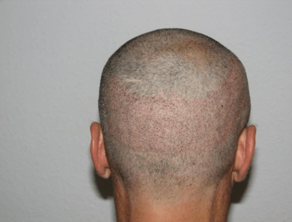 Directly after the surgery with follicular unit extraction