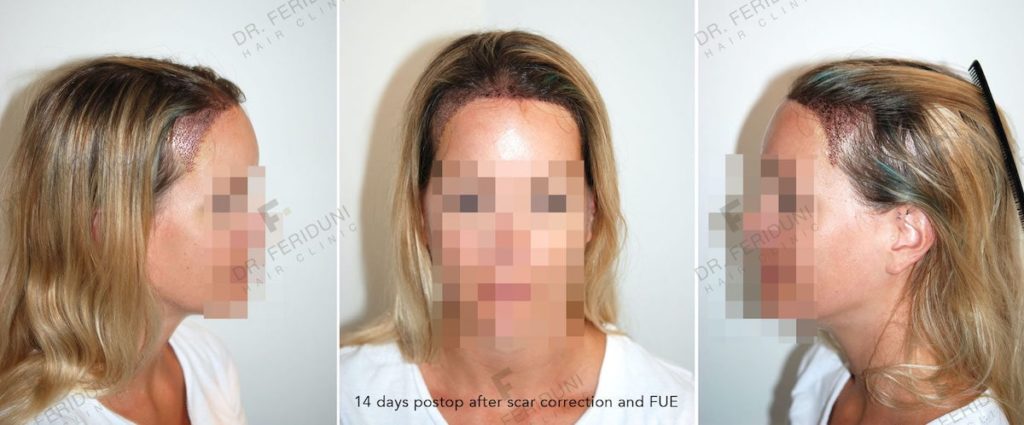 14 days after the scar repair and FUE hair transplantation without short cutting of the hair in the receiving area