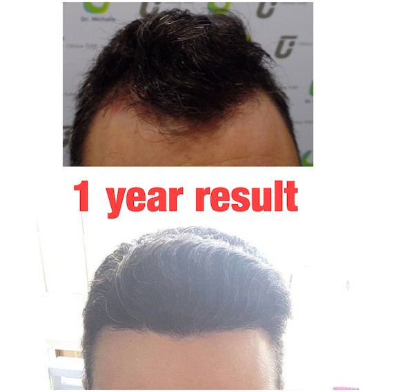 1 year result after transplantation of the receding hairline - Dr. Michalis