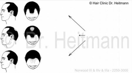 Kosten und Preise einer Haartransplantation bei NWIII_ IIIa_III Vertex