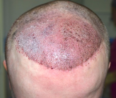 Directly after the repair of the bad hair restoration surgery in germany by Dr. Özgür Öztan - Hairlineclinic