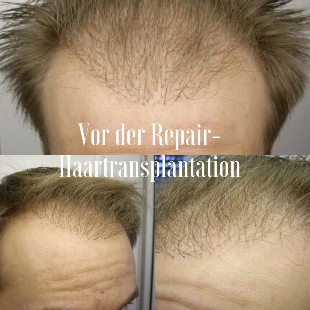 Hair transplant Germany: Result of a failed surgery with thick grafts in the front, poor growth rate and insufficient density