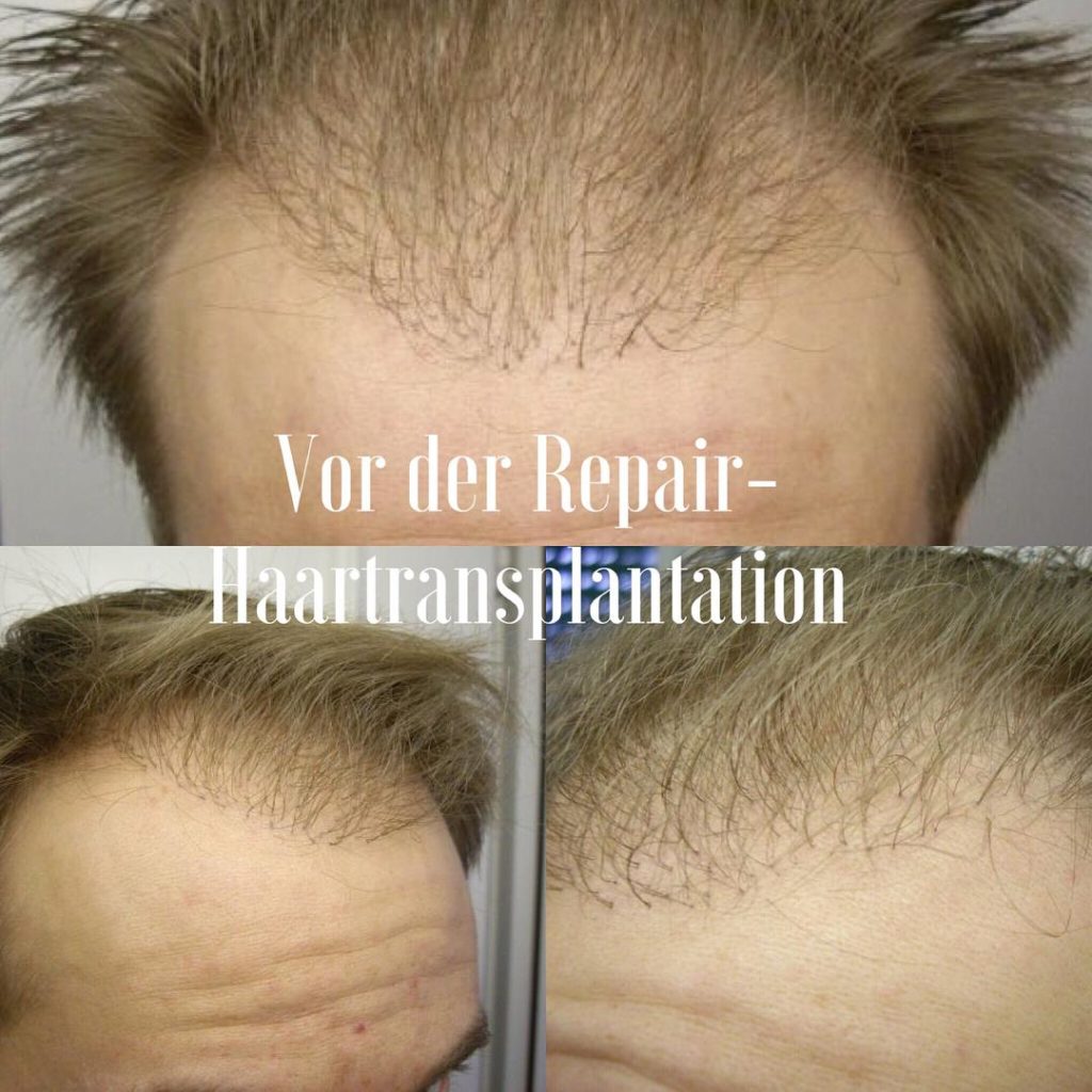 Hair Transplant Clinics Germany 