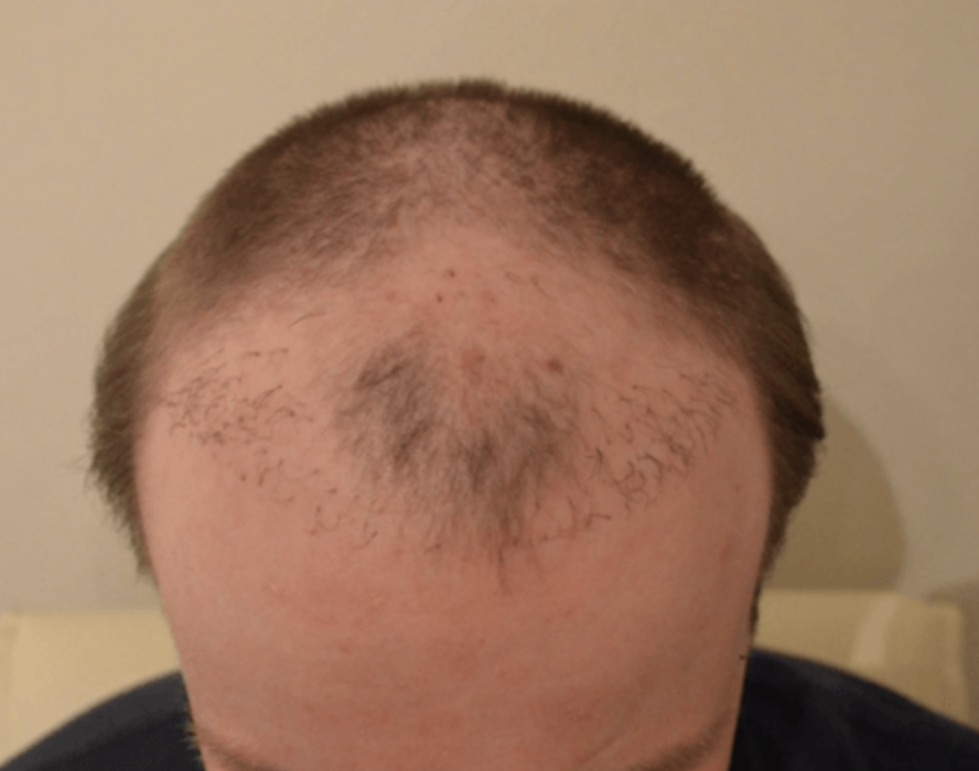 15 Hair transplant ideas  hair transplant transplant hair transplant  surgery