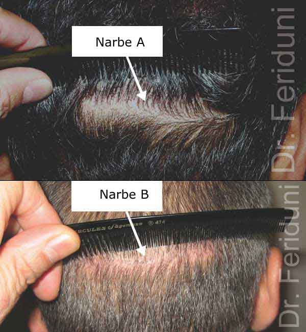 Comparison of the scar after a FUT hair transplantation without and with Trichophytic-Closure closure technique