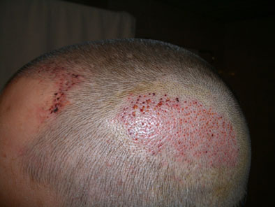 The Donor Area directly after a FUE hair transplant