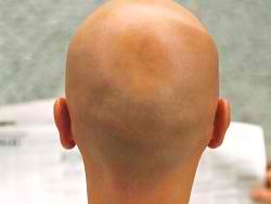 The Donor area for hair transplantation