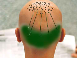 Donor area: Here the hair follicles are removed for the hair restoration surgery and transplanted into bald areas