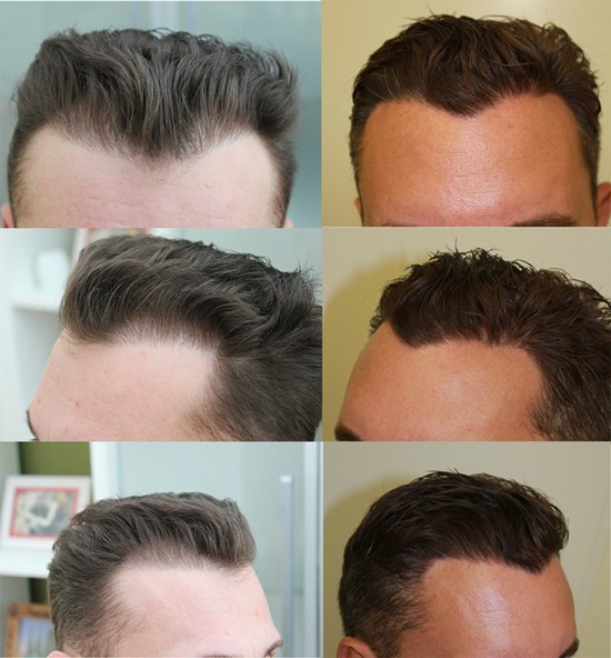 Hair transplant of Dr. Lars Heitmann in Zurich switzerland. Left before the surgery with dr. heitmann and right after