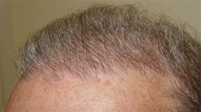Successful and natural result of a hair restoration Example 1 - from the left
