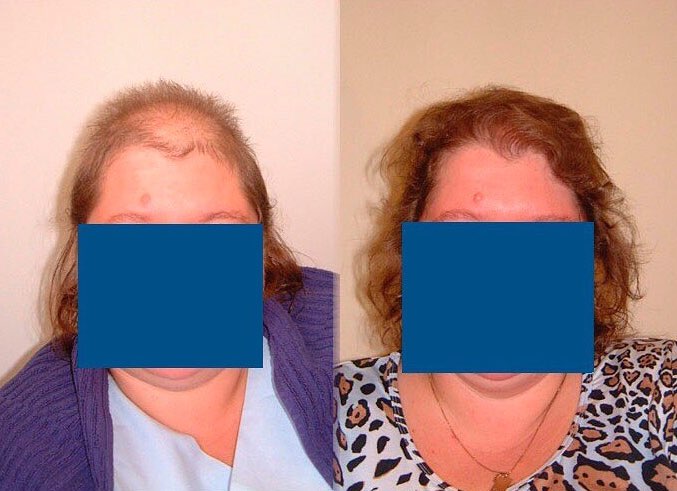 Female hair transplant example from Dr. Lars Heitmann