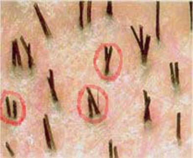 FUE Hair Transplantation and Follicular Units: Hair grows in natural bundles with 1 to 4 hair follicles