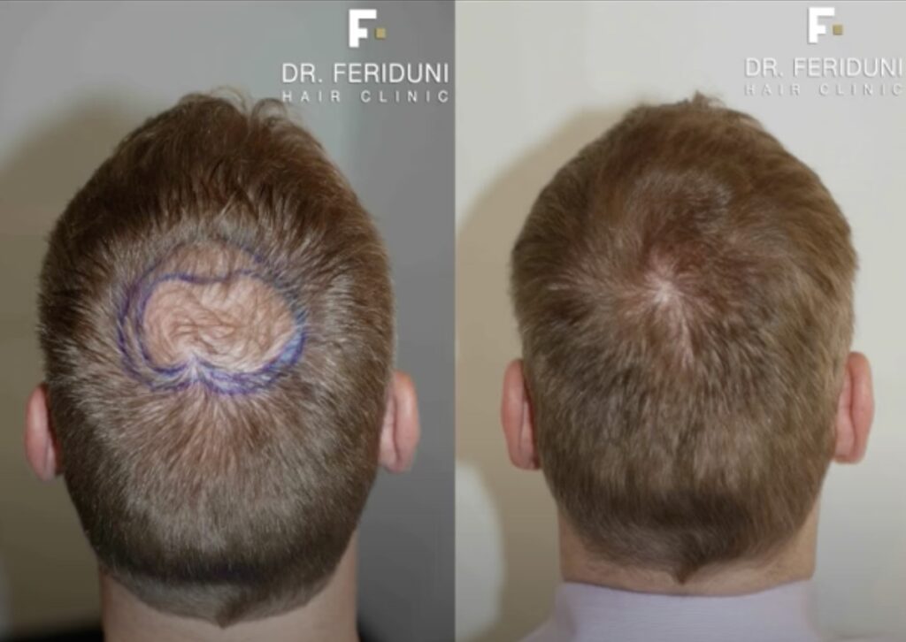 Haartransplantation Tonsur-Glatze und Vorher-Nachher