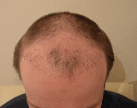 Haartransplantation negative Erfahrungen