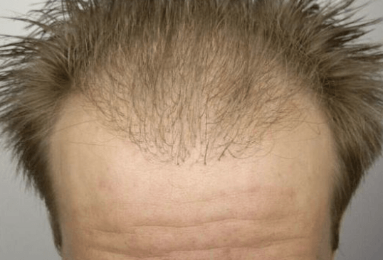 Case Marco after the hair transplantation in Germany and before the corrective surgery from the front close up