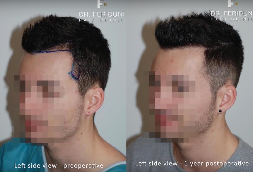 Receding hairline example of Dr. Feriduni with the graft amount from 1401