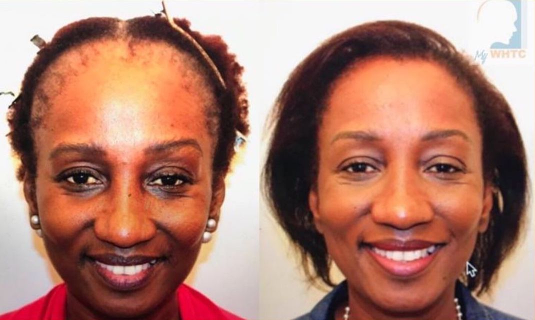 Women fue hair transplantation from Dr. Patrick Mwamba with 1000 Grafts