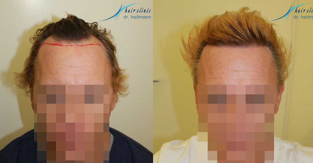 Advance hairline and fill corners with 2400 Grafts from Dr. Heitmann