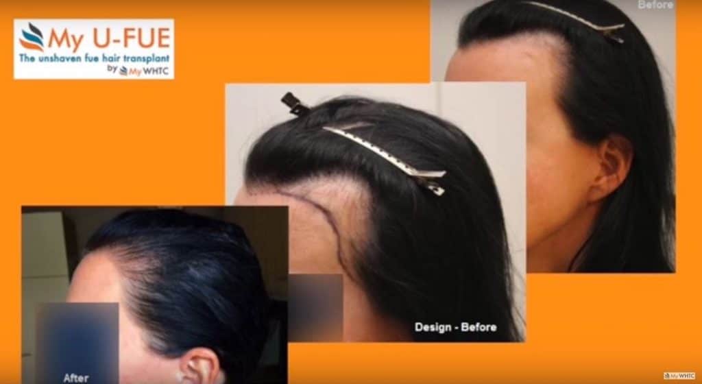 Hair Transplant Women: 1010 grafts into the receding hairline for filling and increase density Dr. Mwamba