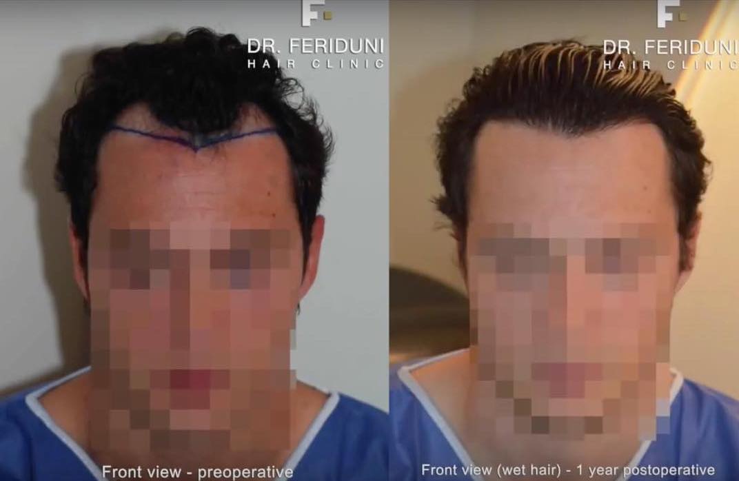 Hair transplant receding hairline with 2485 Grafts