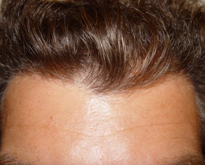 Example 2 of a successful natural hairline with "Dense Packing" trough hair transplantation - from the front