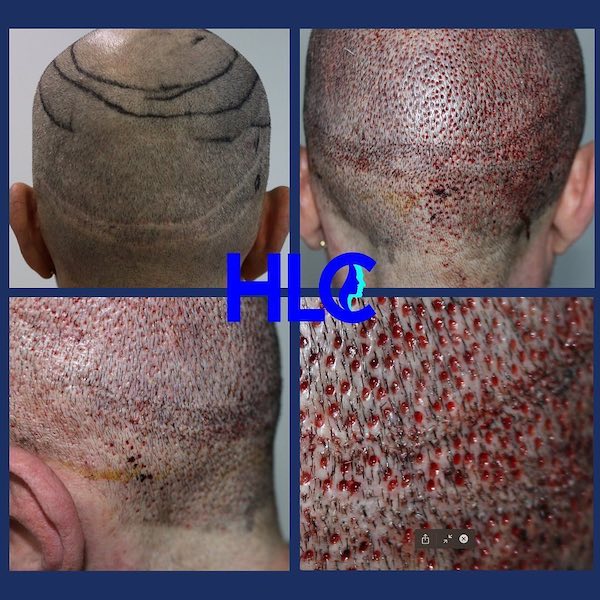 Picture before scar correction and directly after FUT scar correction/repair with FUE and 700-grafts
