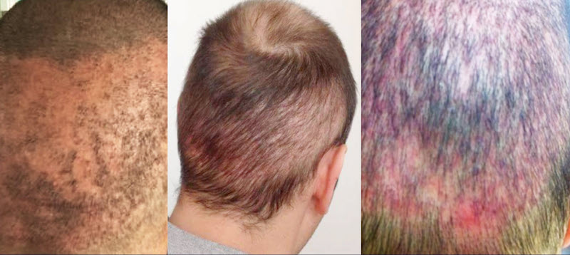 Increased risks in hair transplantation due to excessive extraction in the FUE technique: images ISHRS.org6