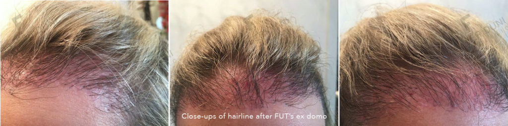 Before the corrective women hair transplant by Dr. Feriduni and after the first two FUT hair transplants with bad experiences: Insufficient density and thicker grafts in the corners and hairline