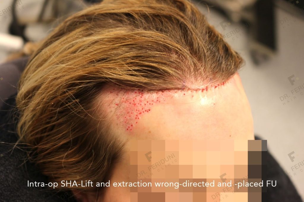 During the SHA procedure and removal of thick multiple grafts in the corners and in the hairline of the woman