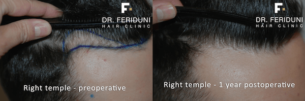 A hair transplant to eliminate and fill a receding hairline: right corner on the left before and right after the surgery