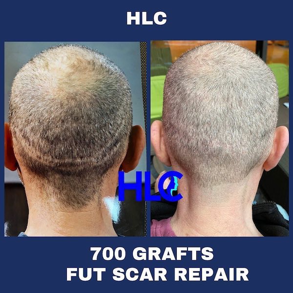 Result of FUT scar grafting/scar correction/scar repair with FUE and 700 grafts