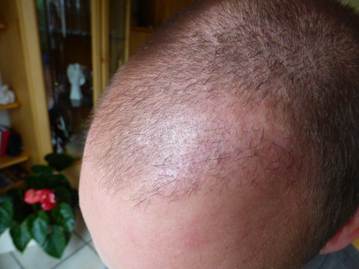 The risks of hair restoration surgery: Poor and low growth rate - Example 1