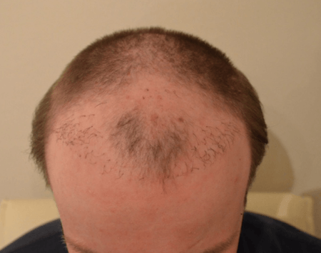 The risks of hair transplant surgery: Poor and low growth rate - Example 2