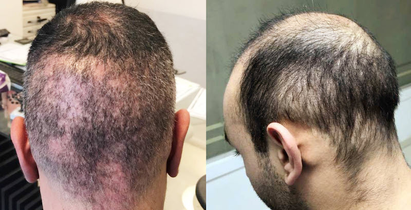 Realistic risk with a cheap FUE hair transplant in a mass hair factory: Permanent thinning and scarring/scarring in the ring of hair/donor area